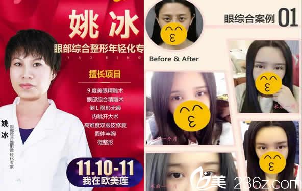 太原歐美蓮整形姚冰及雙眼皮案例圖