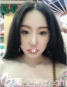 重慶曹陽麗格整形陳滔面部吸脂術(shù)后三個月