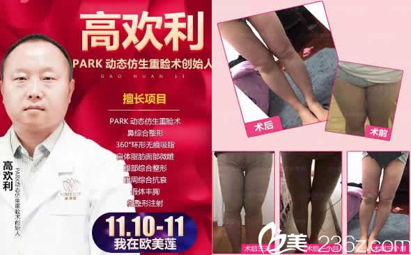 太原歐美蓮整形高歡利及腿部吸脂塑形效果圖