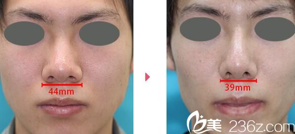 鼻翼縮短 鼻翼縮短