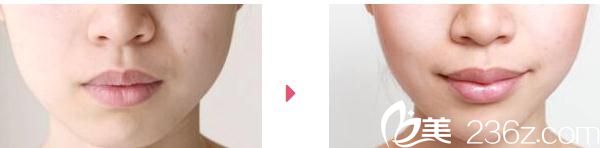 厚唇變薄術(shù) 厚唇變薄術(shù)