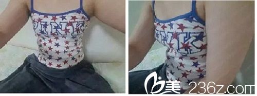 假體隆胸前照片 假體隆胸前照片