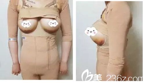 假體隆胸手術(shù)后3天 假體隆胸手術(shù)后3天