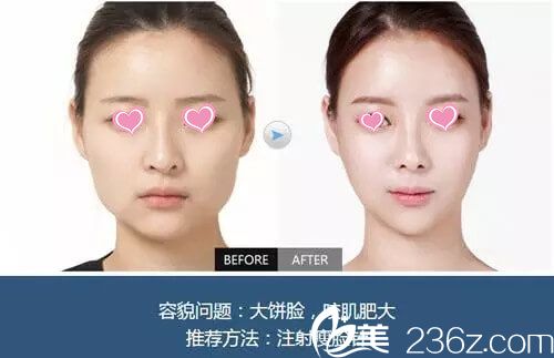 袁抒懷醫(yī)生微整手術(shù)真人案例展示 袁抒懷醫(yī)生微整手術(shù)真人案例展示