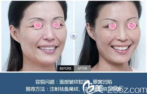 袁抒懷醫(yī)生微整手術(shù)真人案例展示 袁抒懷醫(yī)生微整手術(shù)真人案例展示