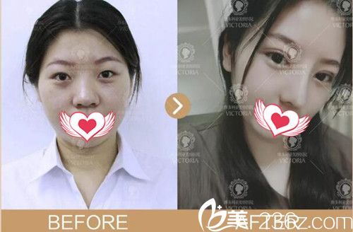 南京維多利亞整形雙眼皮+鼻綜合+玻尿酸案例效果