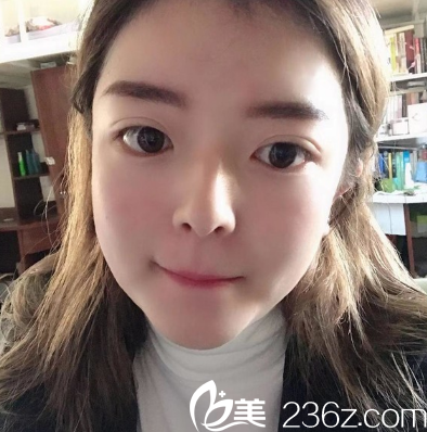 廣州韓妃雙眼皮開眼角術(shù)后15天 廣州韓妃雙眼皮開眼角術(shù)后15天