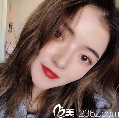 廣州韓妃<!--<i data=20240703-sp></i>-->軍雙眼皮開眼角兩個月案例圖 廣州韓妃<!--<i data=20240703-sp></i>-->軍雙眼皮開眼角兩個月案例圖