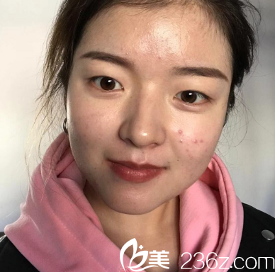 在廣州韓妃做雙眼皮手術(shù)前 在廣州韓妃做雙眼皮手術(shù)前