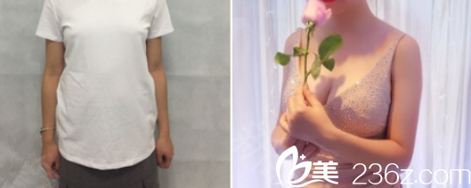 云南華美美萊自體脂肪豐胸案例