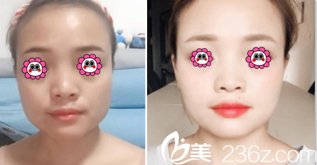 昆明德爾美客自體脂肪面部填充案例