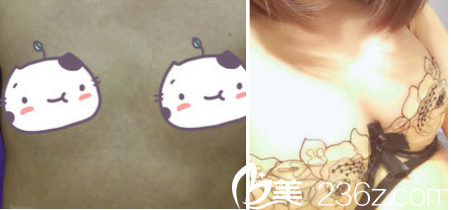 昆明德爾美客自體脂肪豐胸案例