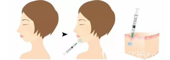 玻尿酸豐下巴過程