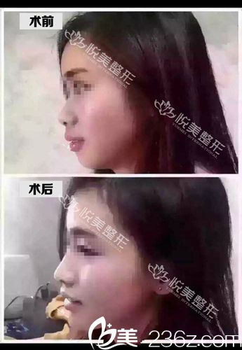 襄陽悅美玻尿酸豐下巴對比案例