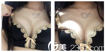 假體隆胸術(shù)后三天恢復效果 假體隆胸術(shù)后三天恢復效果