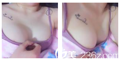 閆愛躍做的280CC傲諾拉假體隆胸半個月效果圖 閆愛躍做的280CC傲諾拉假體隆胸半個月效果圖