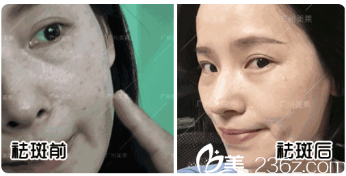 廣州美萊超皮秒祛斑案例 廣州美萊超皮秒祛斑案例