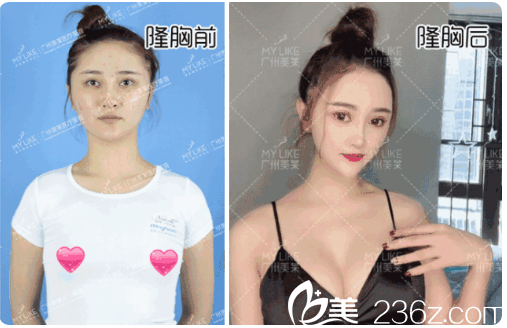 廣州美萊李做的假體隆胸案例 廣州美萊李做的假體隆胸案例