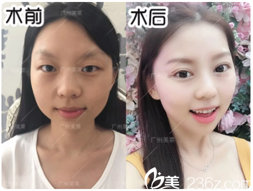 廣州美萊陳貴宗做的雙眼皮案例 廣州美萊陳貴宗做的雙眼皮案例