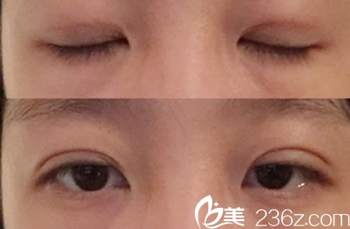 做完雙眼皮手術(shù)7天恢復(fù)照片