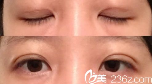 去杭州找閨蜜玩順便到杭州詮昕醫(yī)美周景和院長這做了雙眼皮和開眼角手術(shù)