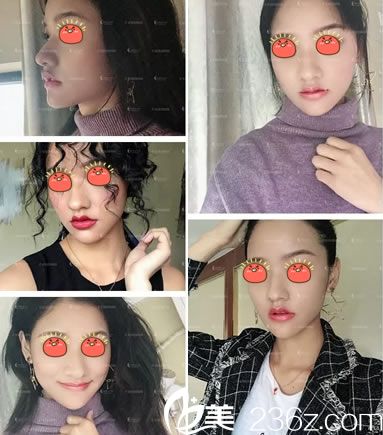 杭州詮昕陳曉曉玻尿酸豐下巴<span style=