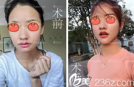 杭州詮昕玻尿酸豐下巴<span style=