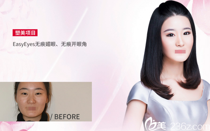 雙眼皮+開眼角案例