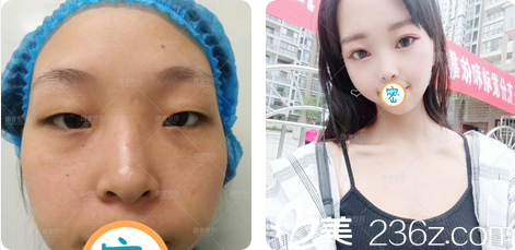 綿陽(yáng)朗睿劉鋒切開雙眼皮術(shù)后效果 綿陽(yáng)朗睿劉鋒切開雙眼皮術(shù)后效果