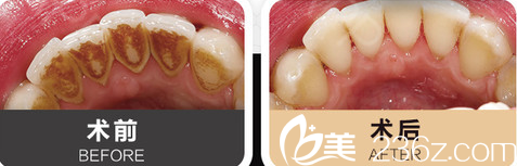 綿陽(yáng)朗睿牙齒美白案例對(duì)比 綿陽(yáng)朗睿牙齒美白案例對(duì)比