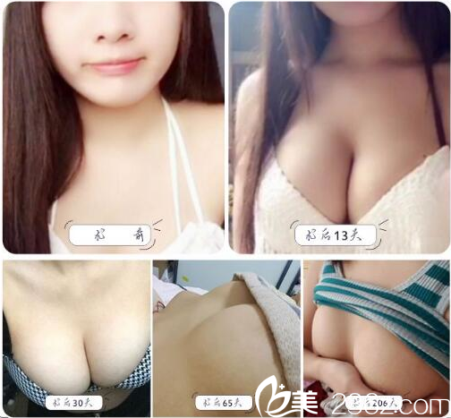 <!--<i data=20240703-sp></i>-->余文林醫(yī)生隆胸案例 <!--<i data=20240703-sp></i>-->余文林醫(yī)生隆胸案例