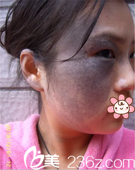 太田痣治療前照片