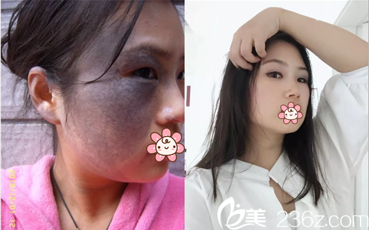 綿陽朗睿王步禮激光祛痣后效果對比