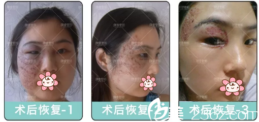 激光去除太田痣治療過程