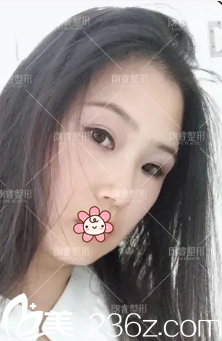 激光去除太田痣治療效果