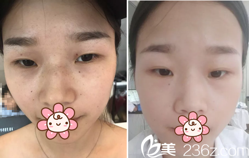 綿陽朗睿激光祛雀斑案例對比