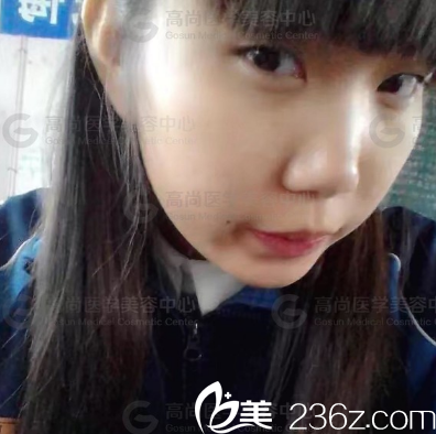 在廣州高尚醫(yī)學(xué)美容中心做整形手術(shù)前 在廣州高尚醫(yī)學(xué)美容中心做整形手術(shù)前