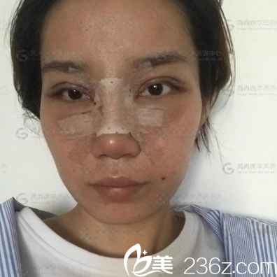 廣州高尚醫(yī)學(xué)美容中心雙眼皮隆鼻案例術(shù)后四天圖片 廣州高尚醫(yī)學(xué)美容中心雙眼皮隆鼻案例術(shù)后四天圖片