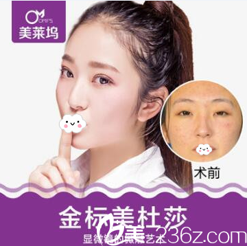 淮北東方美萊塢雙眼皮+開眼角綜合整形案例