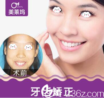 淮北東方美萊塢牙齒矯正真人案例