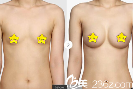 淮北時光假體隆胸真人案例效果對比圖