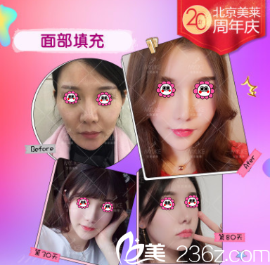 北京美萊黃杰面部脂肪填充<span style=