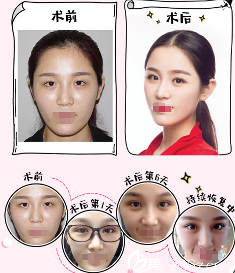 無錫愛思特春天雙眼皮案例