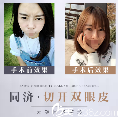 無錫同舟醫(yī)療美容醫(yī)院雙眼皮案例