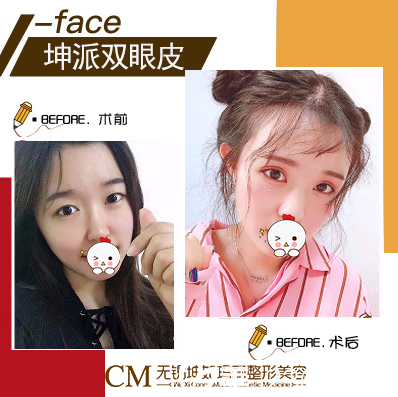 無錫坤如瑪麗整形醫(yī)院雙眼皮案例