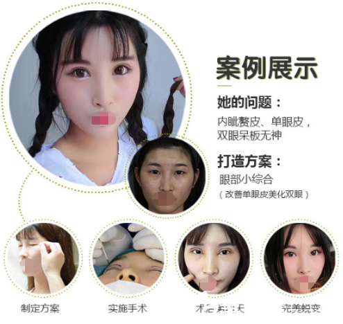 <!--<i data=20240703-sp></i>-->美聯(lián)臣整形醫(yī)院雙眼皮案例