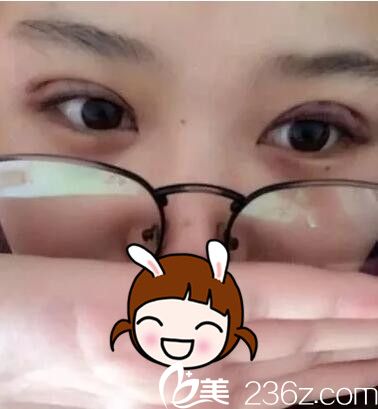 剛做完韓式三點雙眼皮