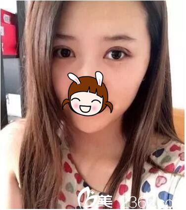 術(shù)后2天雙眼皮恢復(fù)中