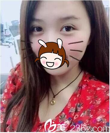 一周韓式雙眼皮恢復(fù)