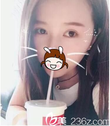 韓式三點定位雙眼皮術(shù)后半個月恢復(fù)